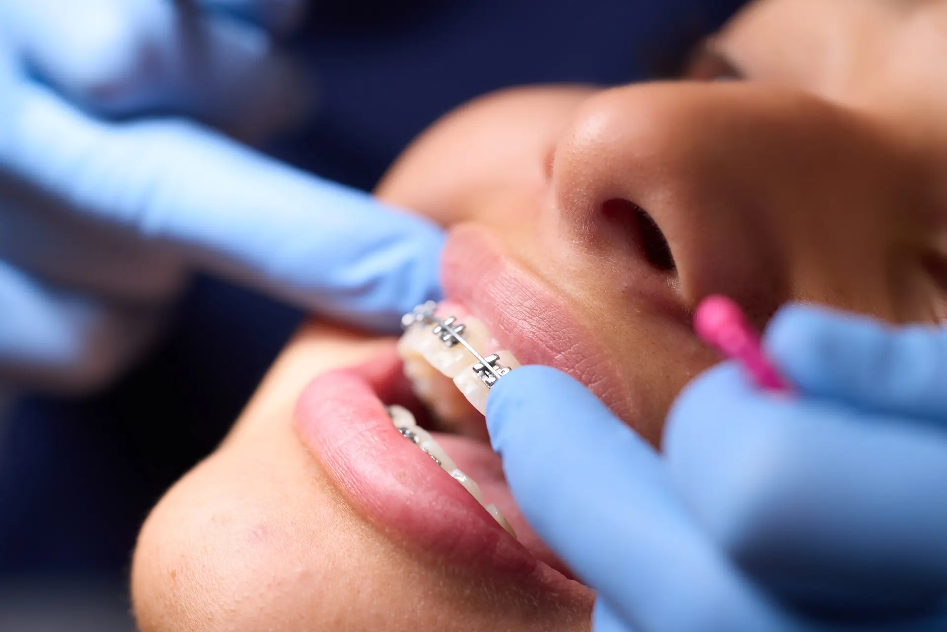 Pose d'un appareil orthodontique multibague au cabinet du Dr Ludovica Martini à Athis-Mons